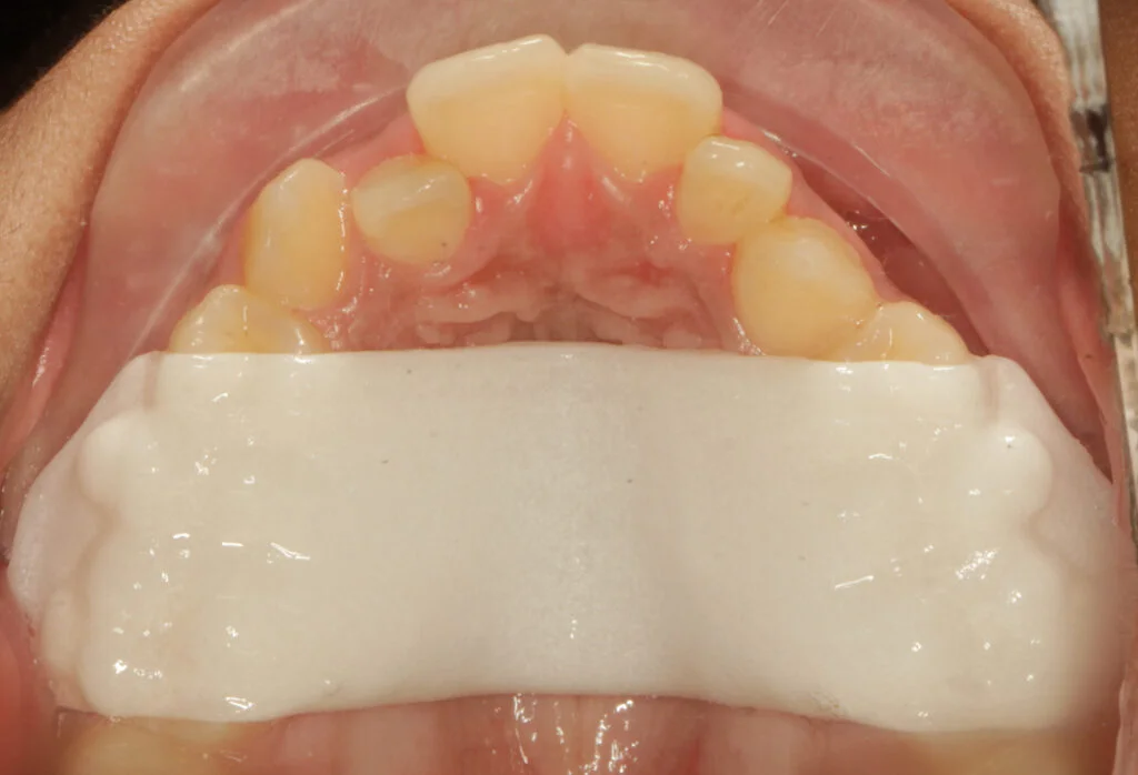 Palatal expander treatment for children at Dr Batra's Dental Hub, South Bopal