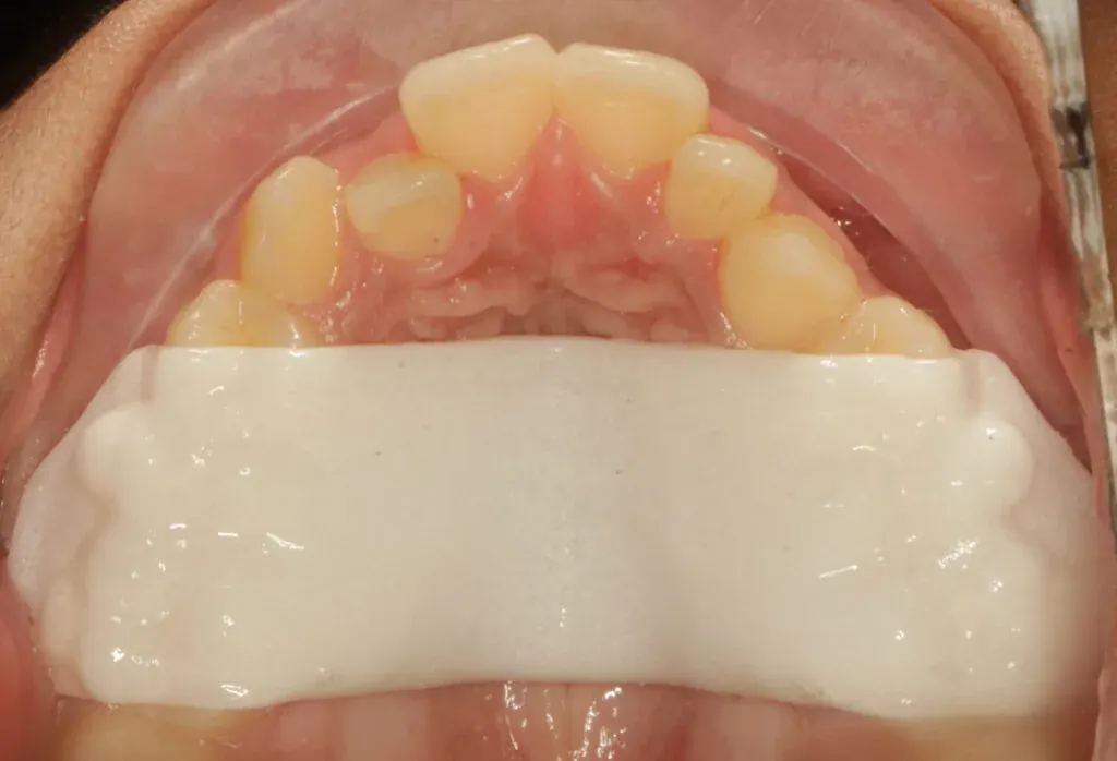 Palatal expander treatment for children at Dr Batra's Dental Hub, South Bopal
