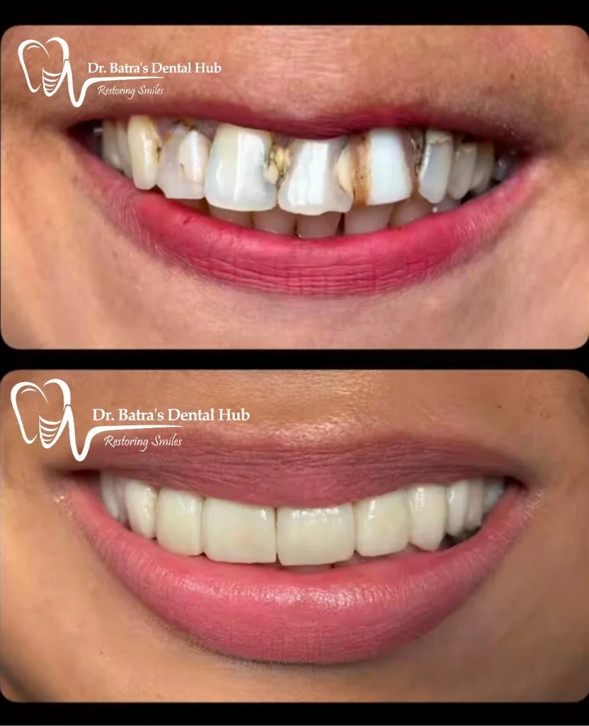 Anterior Aesthetic Rehabilitation before and after case by Dr Batra's Dental Hub