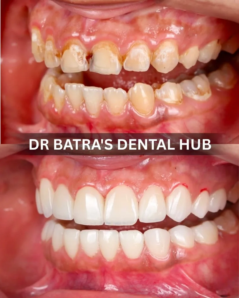 Anterior Crowns and Veneers cosmetic makeover before and after case by Dr Batra's Dental Hub