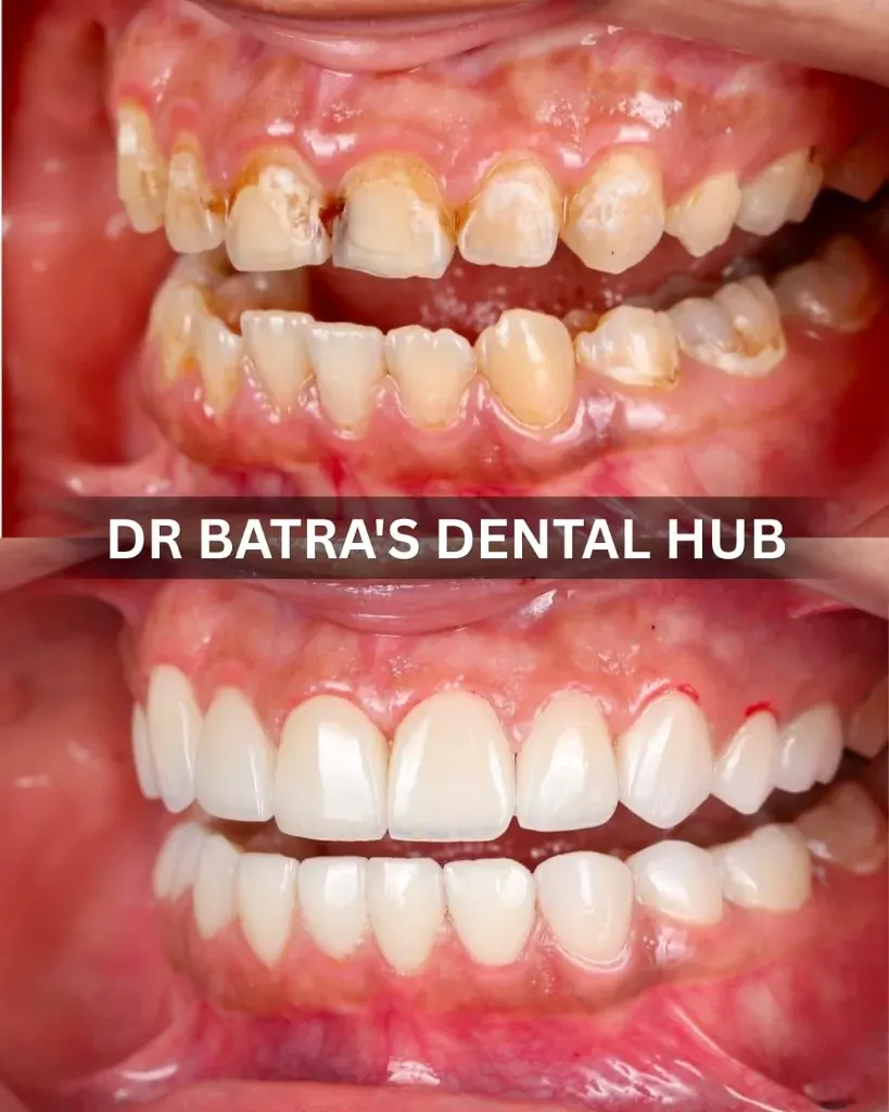 Anterior Crowns and Veneers cosmetic makeover before and after case by Dr Batra's Dental Hub