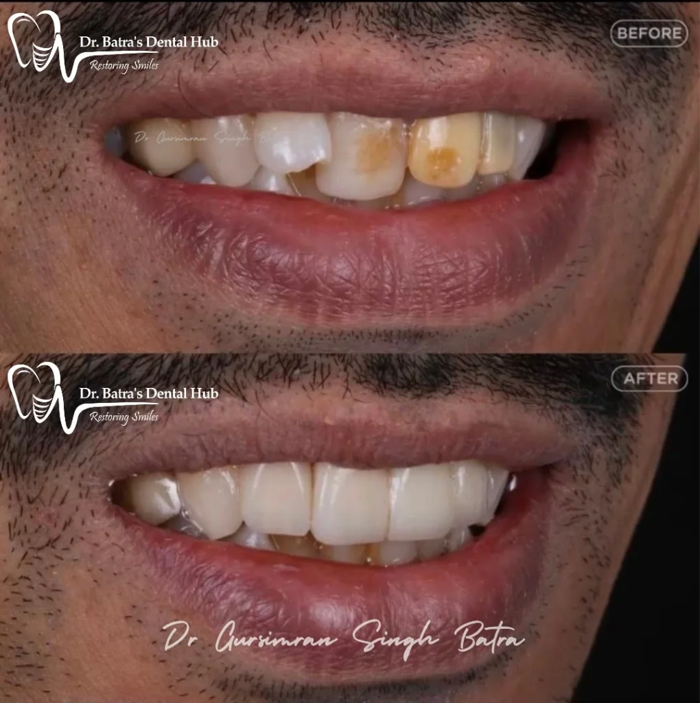 Anterior Esthetic Crowns before and after case by Dr Batra's Dental Hub