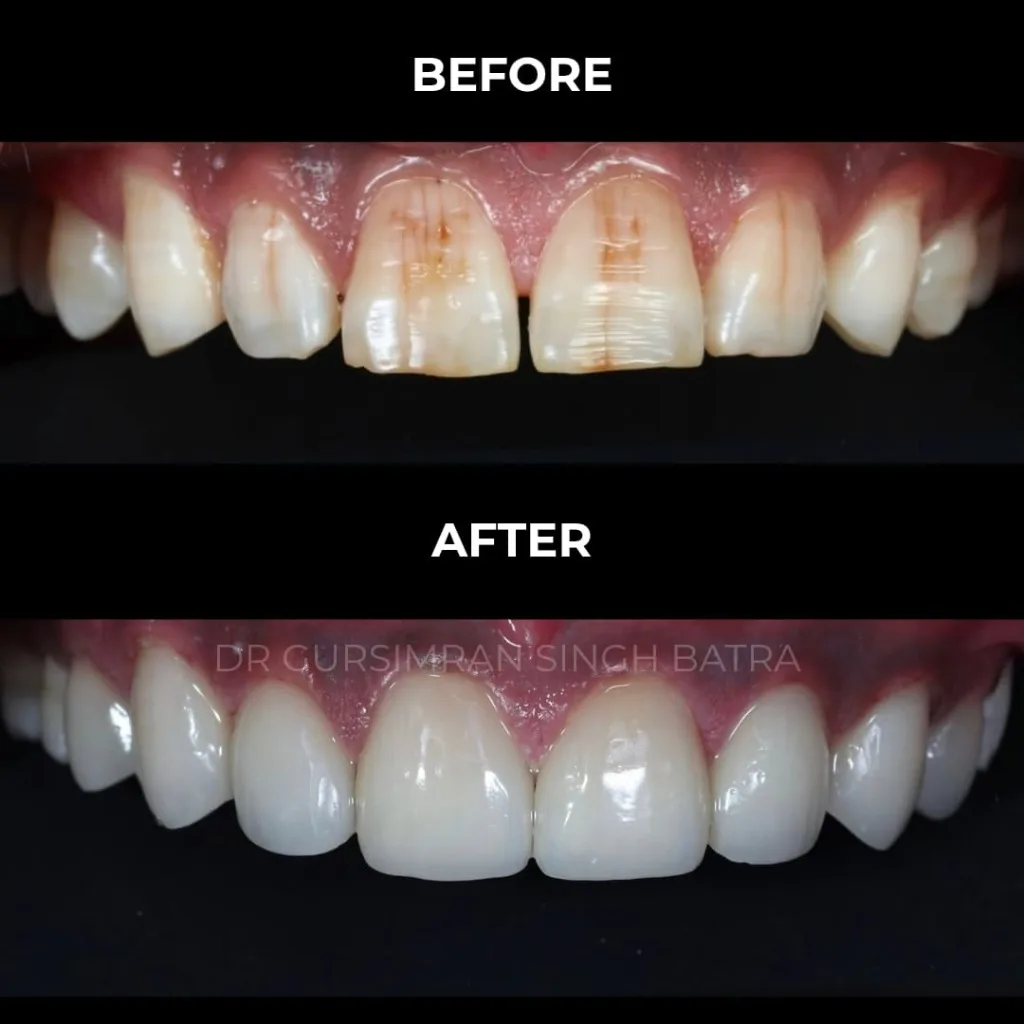 Anterior Veneers smile makeover before and after case by Dr Batra's Dental Hub