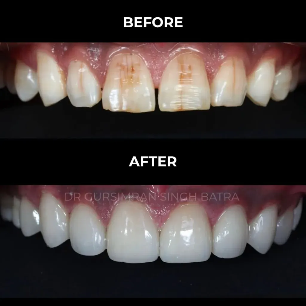 Anterior Veneers smile makeover before and after case by Dr Batra's Dental Hub