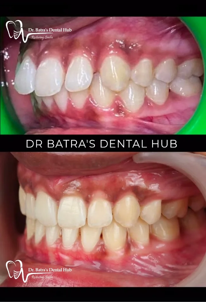 Crowded Teeth Realignment before and after case by Dr Batra's Dental Hub
