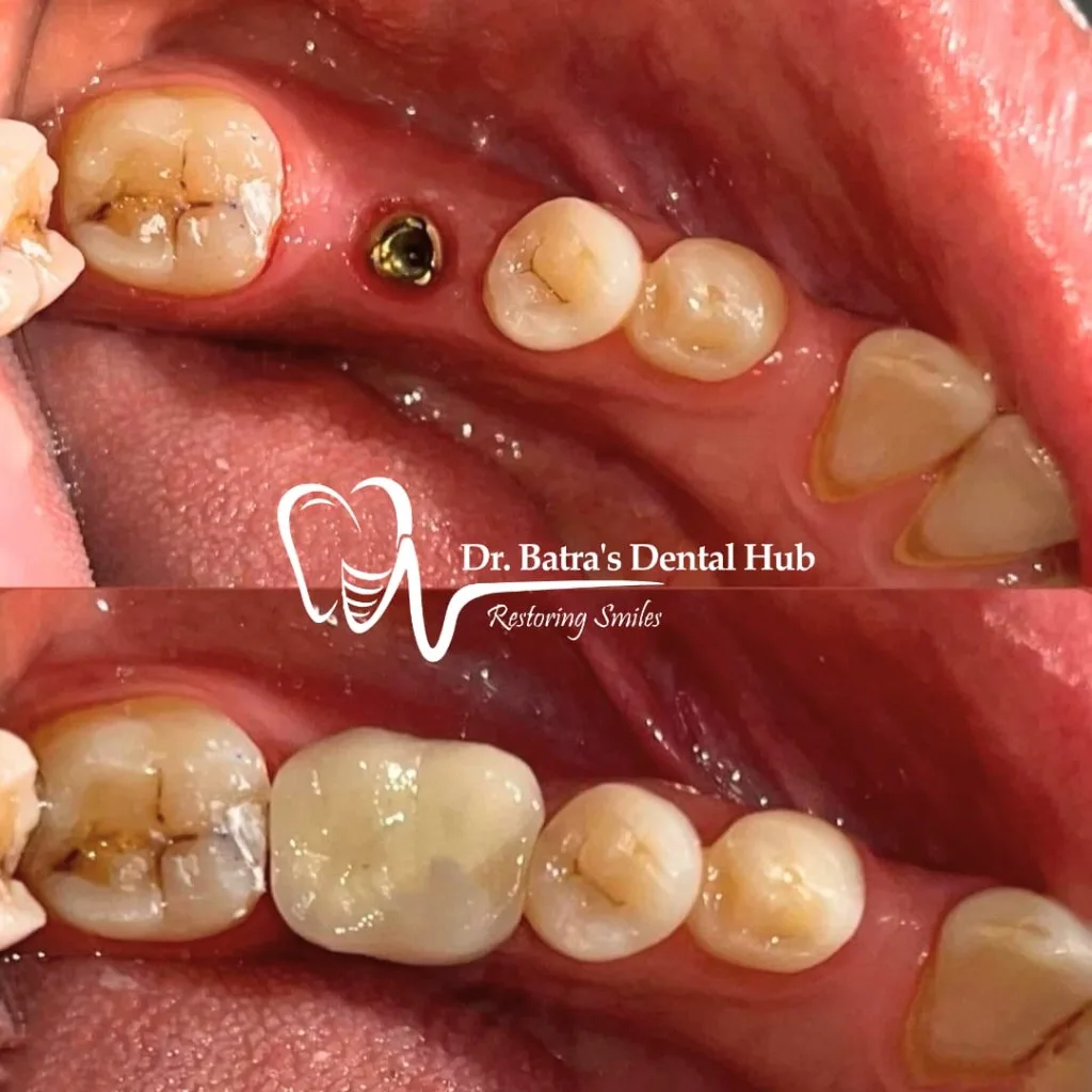 Single Dental Implant placement before and after case by Dr Batra's Dental Hub