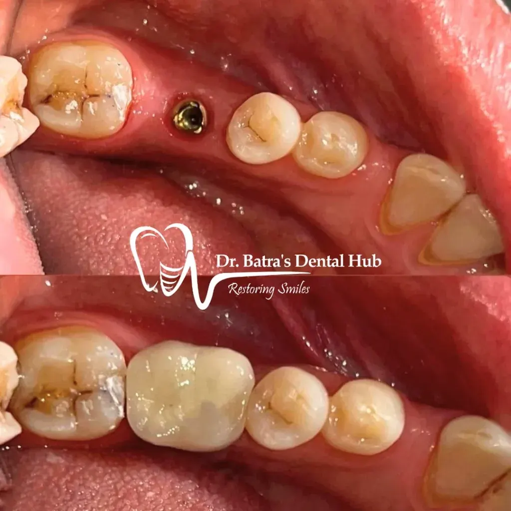Single Dental Implant placement before and after case by Dr Batra's Dental Hub