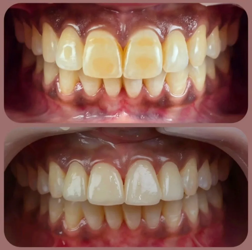 Fluorosis and stain correction cosmetic bonding before and after case by Dr Batra's Dental Hub