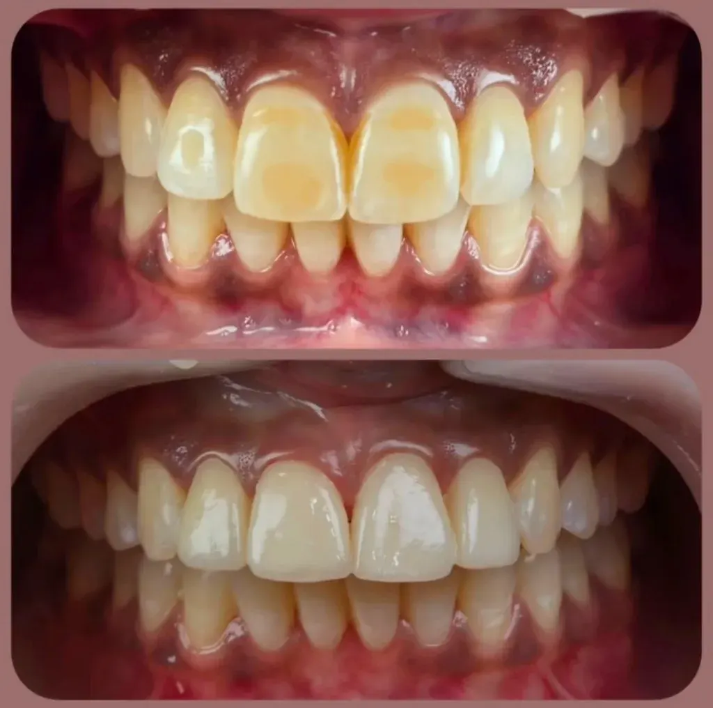 Fluorosis and stain correction cosmetic bonding before and after case by Dr Batra's Dental Hub