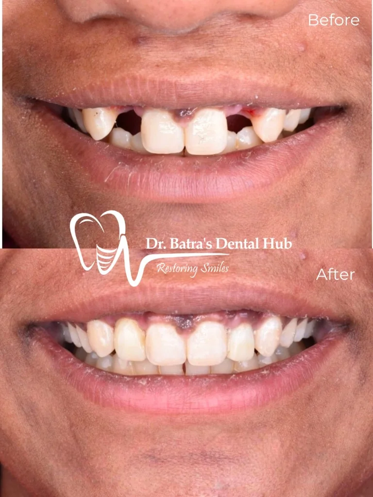Anterior Fixed Bridge Restorations before and after case by Dr Batra's Dental Hub