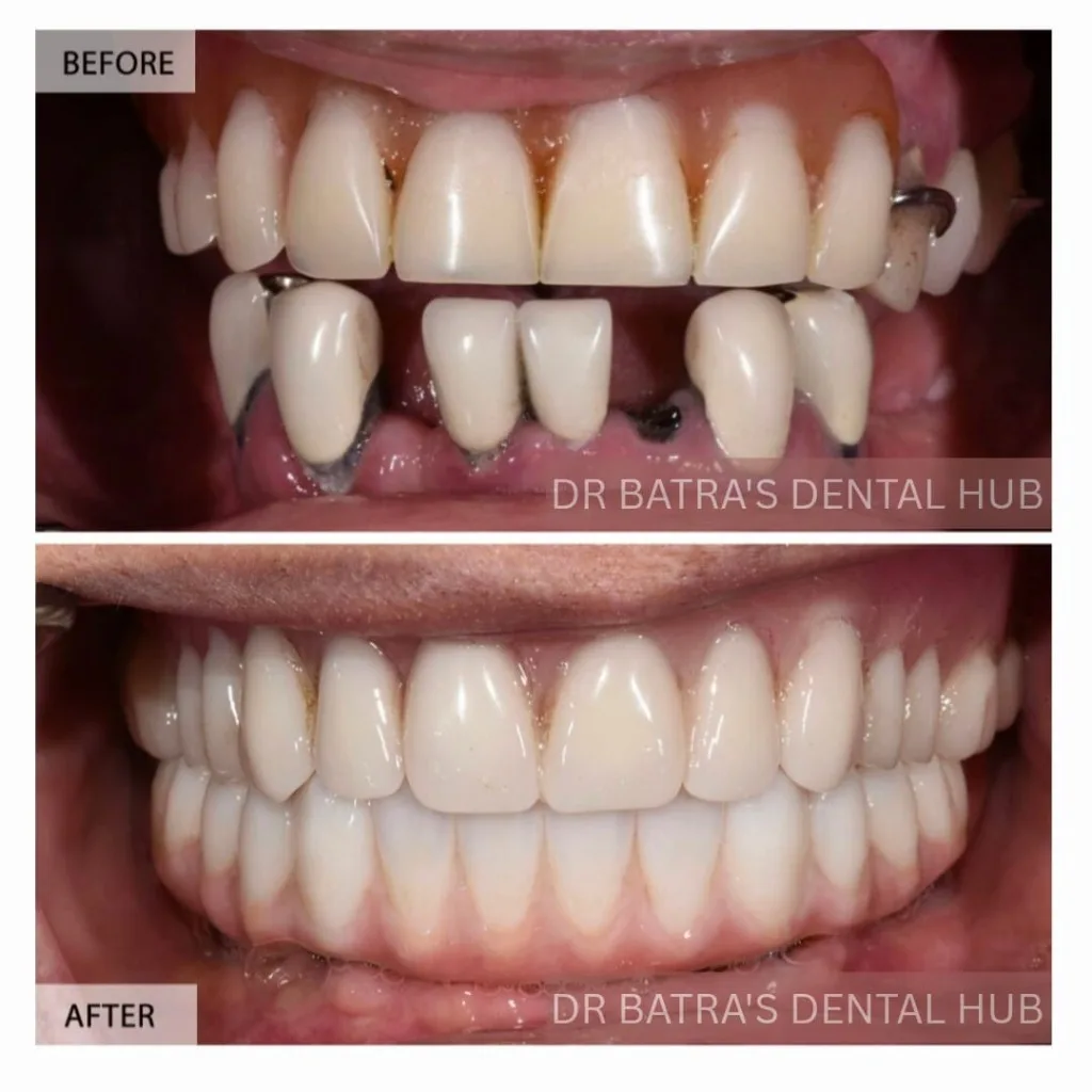 Implant-supported full mouth rehabilitation before and after case by Dr Batra's Dental Hub