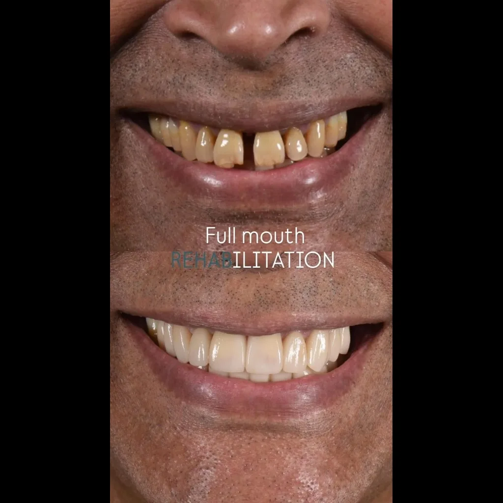 Full Mouth Rehabilitation restorative dentistry before and after case by Dr Batra's Dental Hub