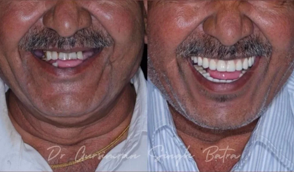 Geriatric full mouth dentures and bridges reconstruction before and after case by Dr Batra's Dental Hub