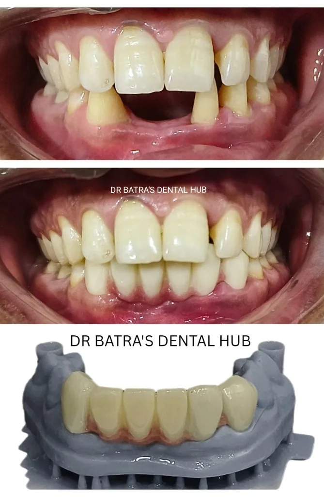 Lower Anterior Bridge Restoration before and after case by Dr Batra's Dental Hub