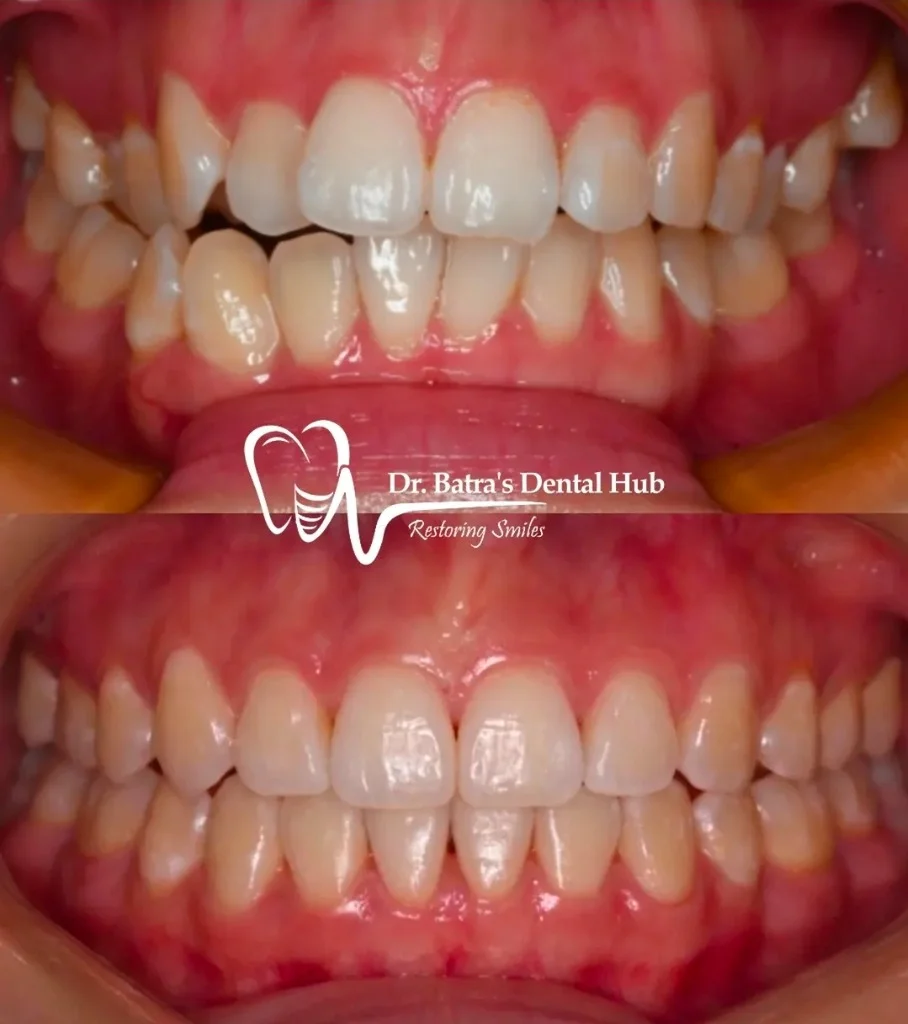 Orthodontic Alignment Transformation before and after case by Dr Batra's Dental Hub