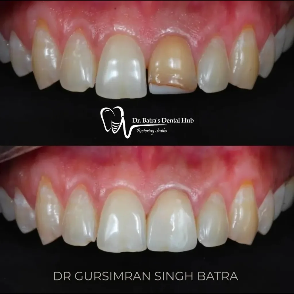 Single Front Tooth Crown before and after case by Dr Batra's Dental Hub