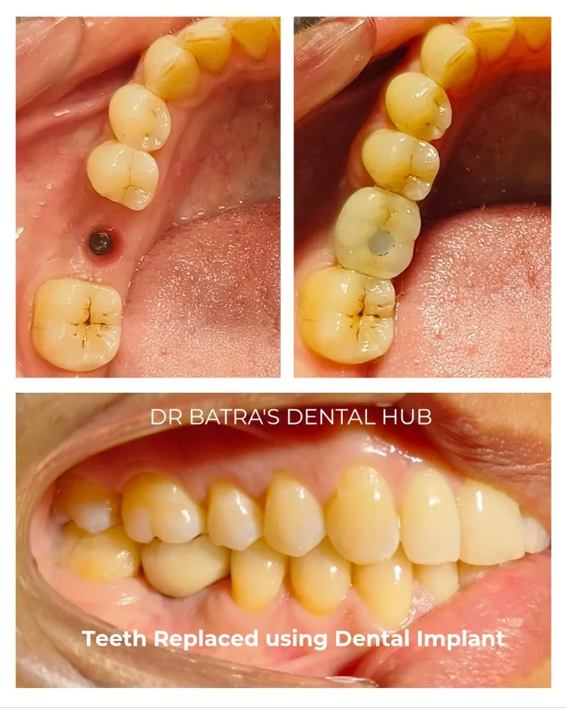 Single molar posterior dental implant placement and crown loading before and after case by Dr Batra's Dental Hub