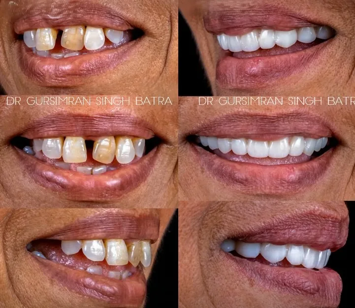 Cosmetic Smile Makeover spacing correction before and after case by Dr Batra's Dental Hub