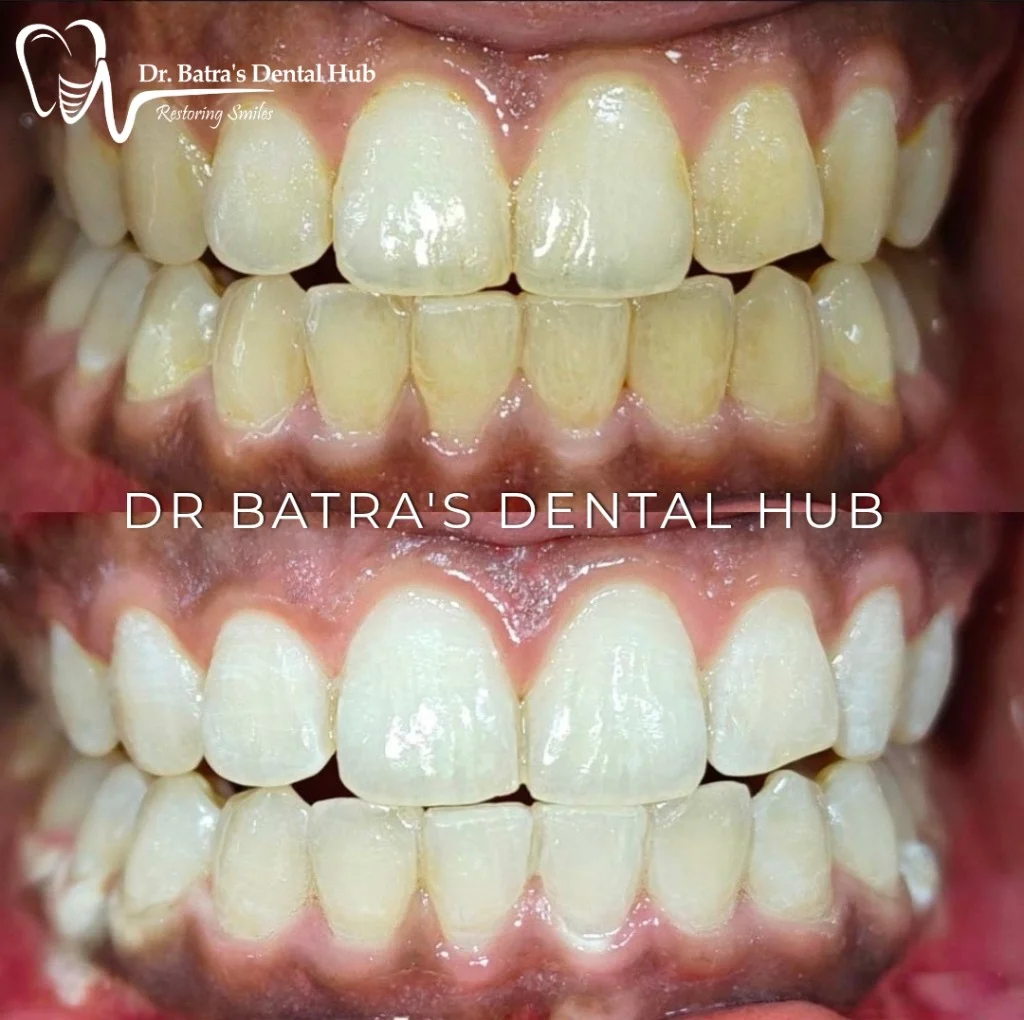 Professional Teeth Whitening before and after case by Dr Batra's Dental Hub