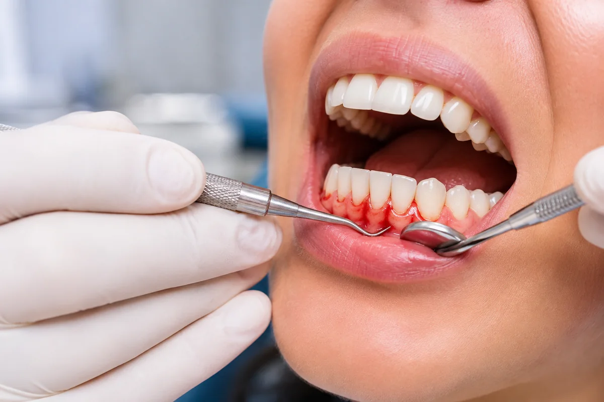 Gum disease and periodontal treatment in South Bopal, Ahmedabad
