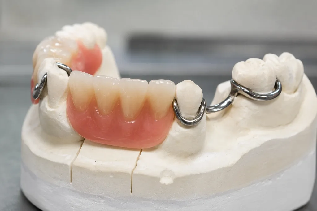 Semi Fixed Removable Overdentures Ahmedabad
